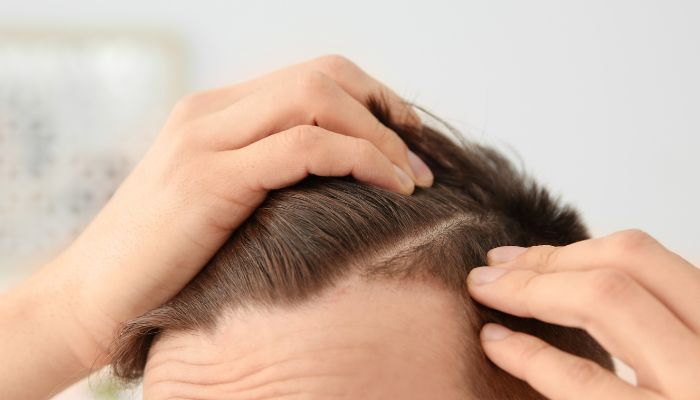 Common Causes of Hair Loss in Men