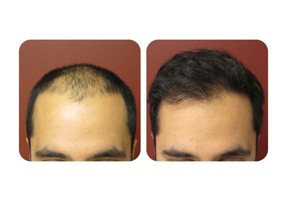 hair-restoration-patients1