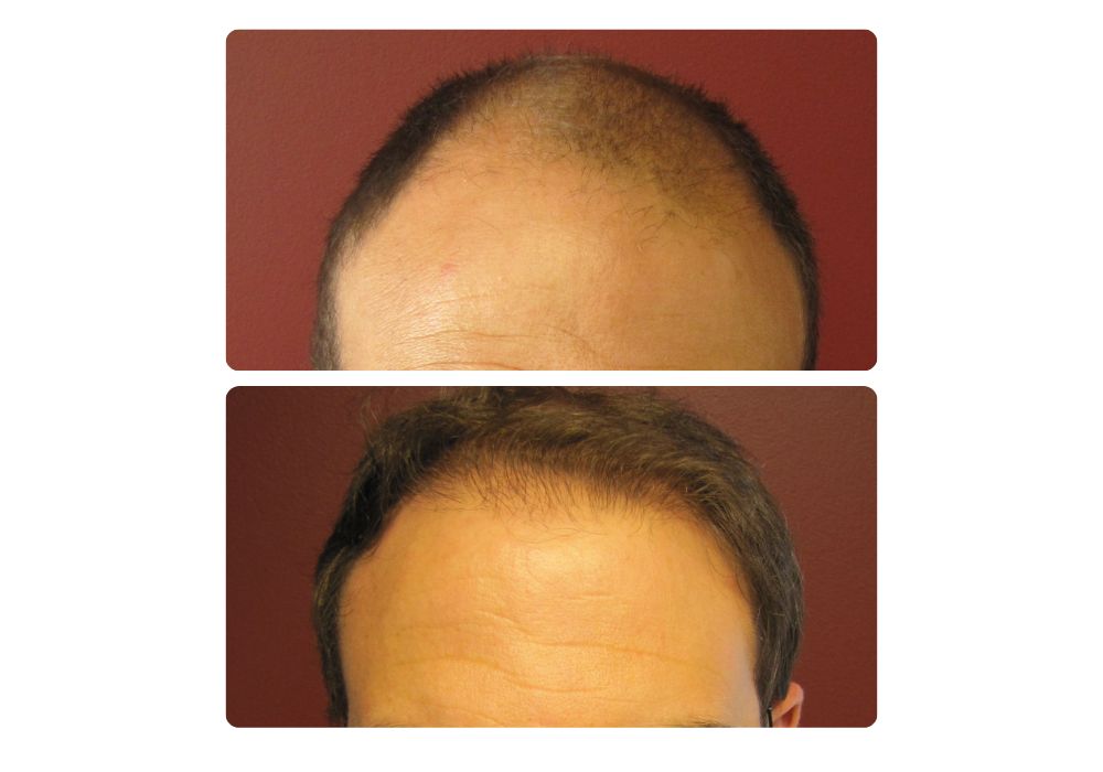 hair-restoration-patients2