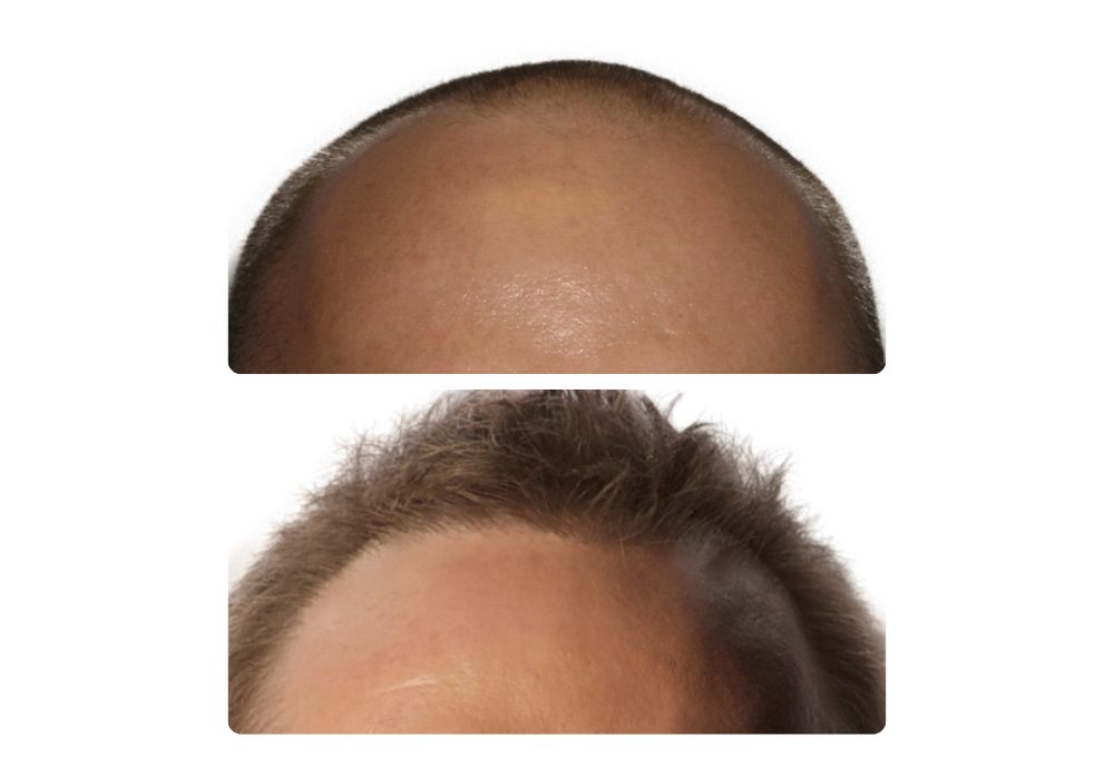 hair-restoration-patients3