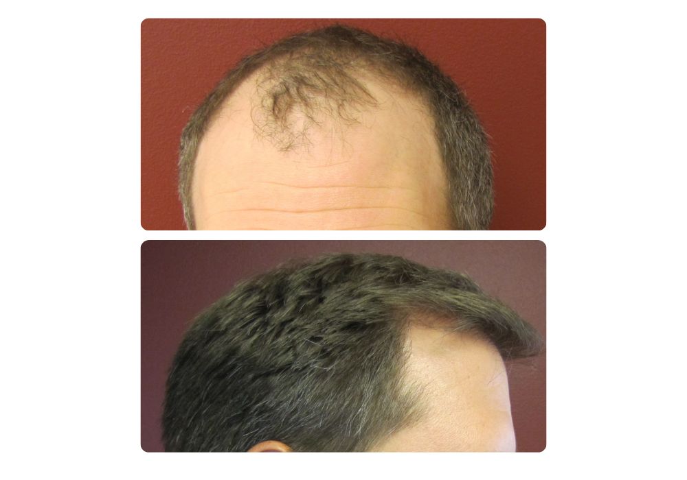 hair-restoration-patients4