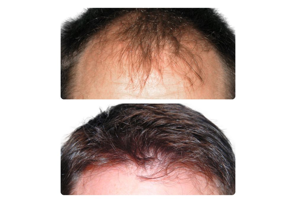 hair-restoration-patients5