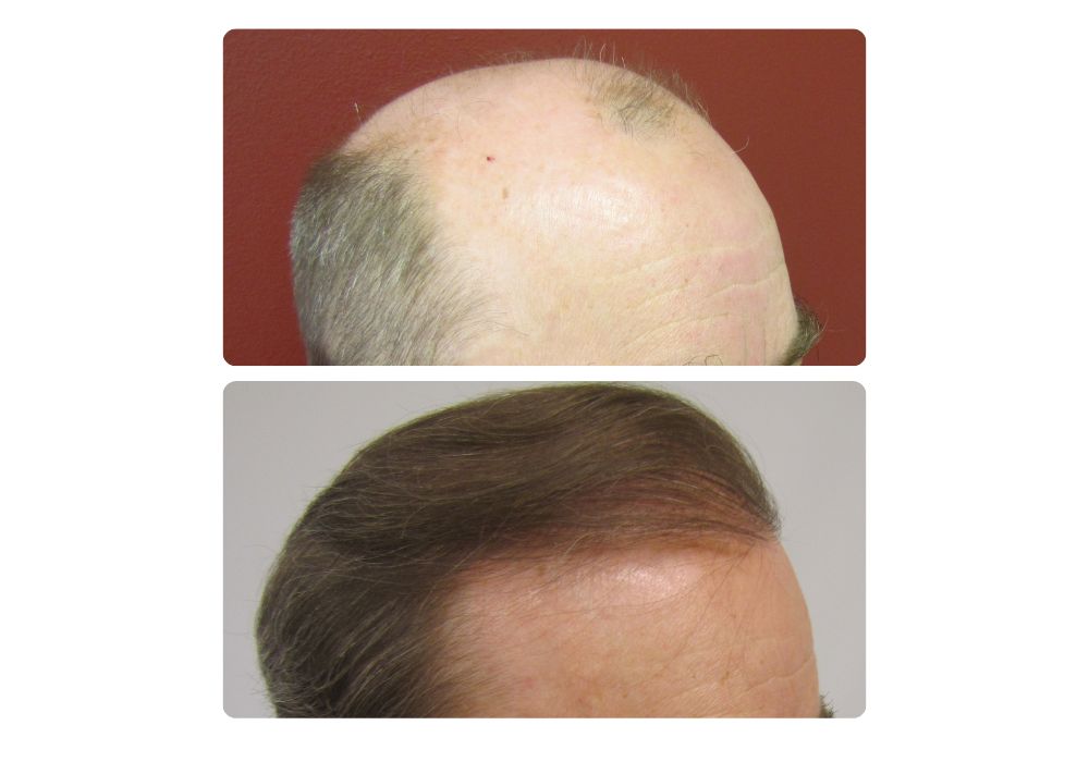 hair-restoration-patients6