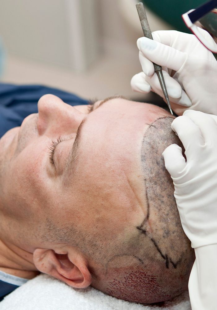 strip hair transplant michigan