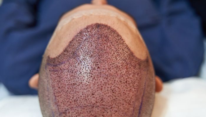 Transform Scars and Bald Areas with Scalp Micropigmentation