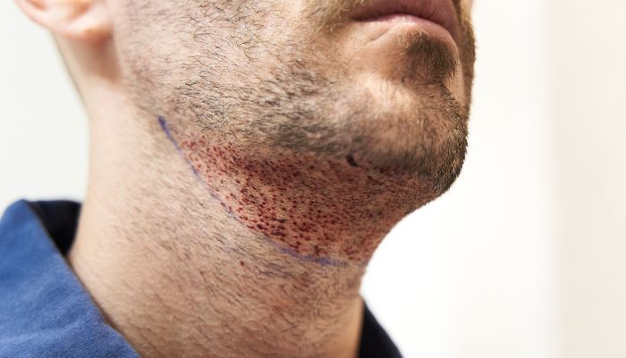 Transform Your Appearance with Facial Hair Transplants