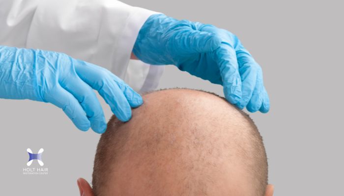 Strip Hair Transplant in Michigan