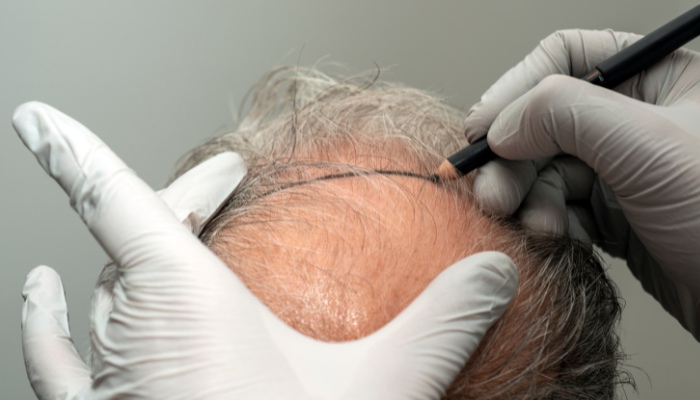 Strip Hair Transplant: Everything You Need to Know