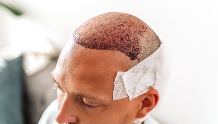 how to sleep after an ARTAS hair transplant - discover best practices