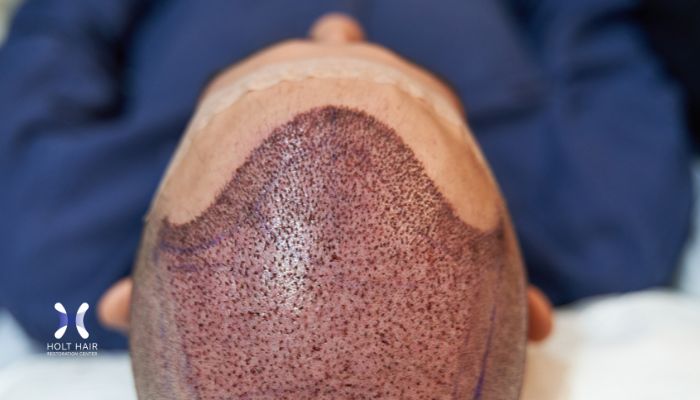 how to sleep after ARTAS hair transplant