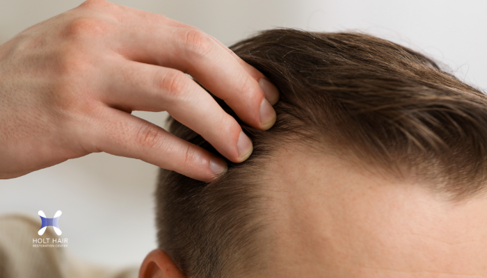 receding hairline causes