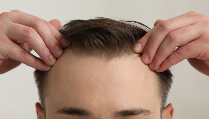receding hairline causes
