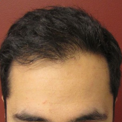 Holt Hair Restoration patient 1 after hair restoration