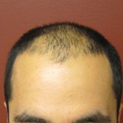 Holt Hair Restoration patient 1 before treatment