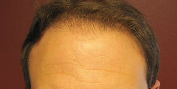 Holt Hair Restoration patient 2 after hair restoration