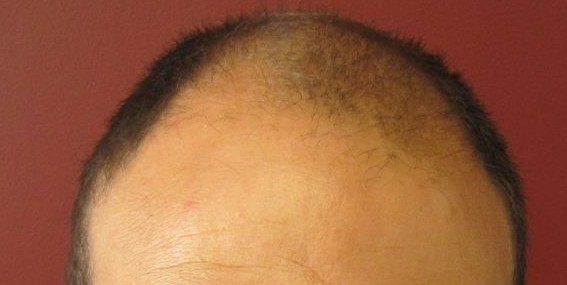 Holt Hair Restoration patient 2 before treatment