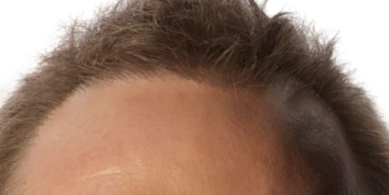 Holt Hair Restoration patient 3 after hair restoration