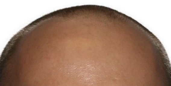 Holt Hair Restoration patient 3 before treatment