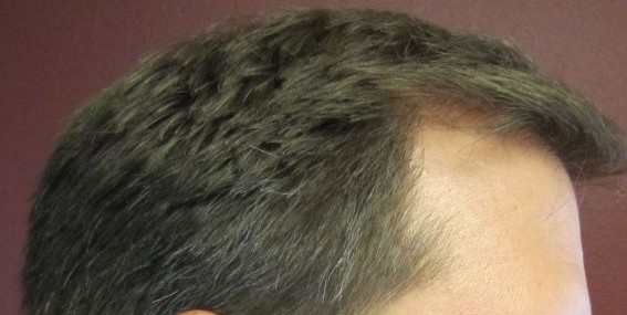 Holt Hair Restoration patient 4 after hair restoration