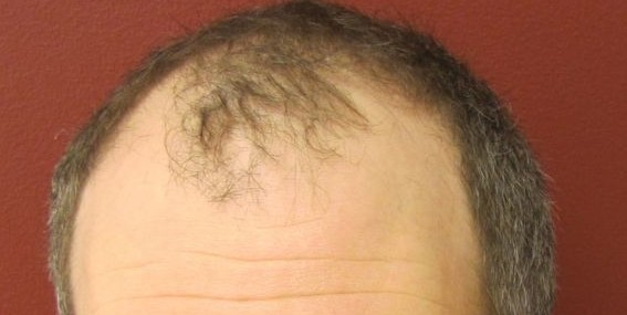Holt Hair Restoration patient 4 before treatment
