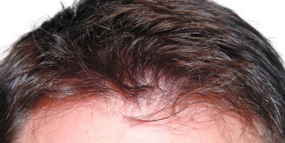 Holt Hair Restoration patient 5 after hair restoration