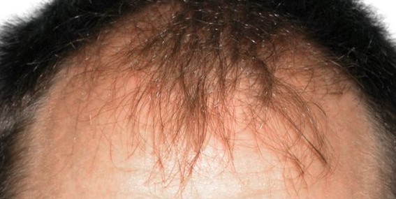 Holt Hair Restoration patient 5 before treatment