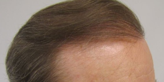 Holt Hair Restoration patient 6 after hair restoration