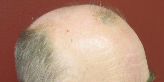 Holt Hair Restoration patient 6 before treatment
